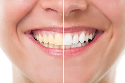 womans smile before and after her nashville teeth whitening