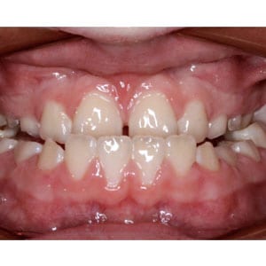 teeth with underbite that will be corrected with invisalign at tri city dental care