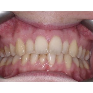 teeth with mild crowding that will be corrected with invisalign at tri city dental care