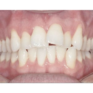 teeth with moderate crowding that will be corrected with invisalign at tri city dental care