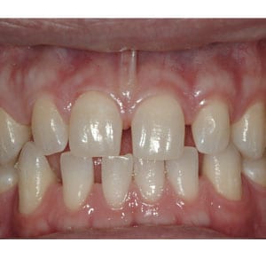 teeth with moderate spacing that will be corrected with invisalign at tri city dental care