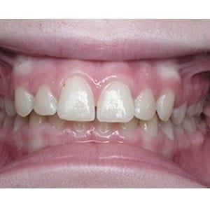teeth with overbite that will be corrected with invisalign at tri city dental care