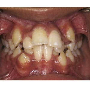 teeth with severe crowding that will be corrected with invisalign at tri city dental care